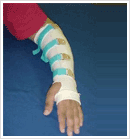 Orthotics Arm Elbow Braces